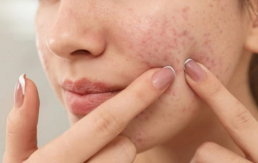 We Can Treat Acne, But We Cannot Cure It