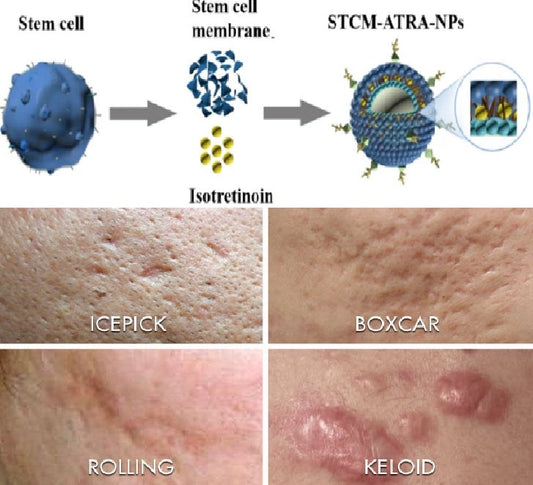 Stem Cells: A Solution for Cystic Acne flawlesseternalbeauty