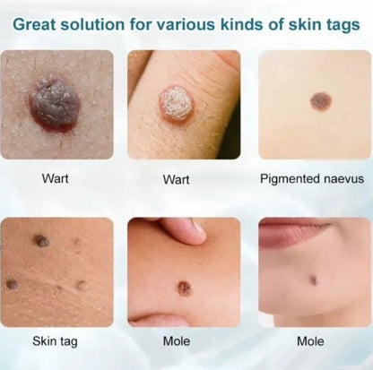 Apgar Herbal Skin Tag Removal Cream 5g