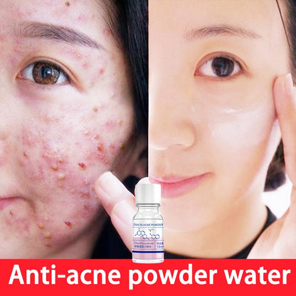 Pink Diacid Acne Powder Water 10ml